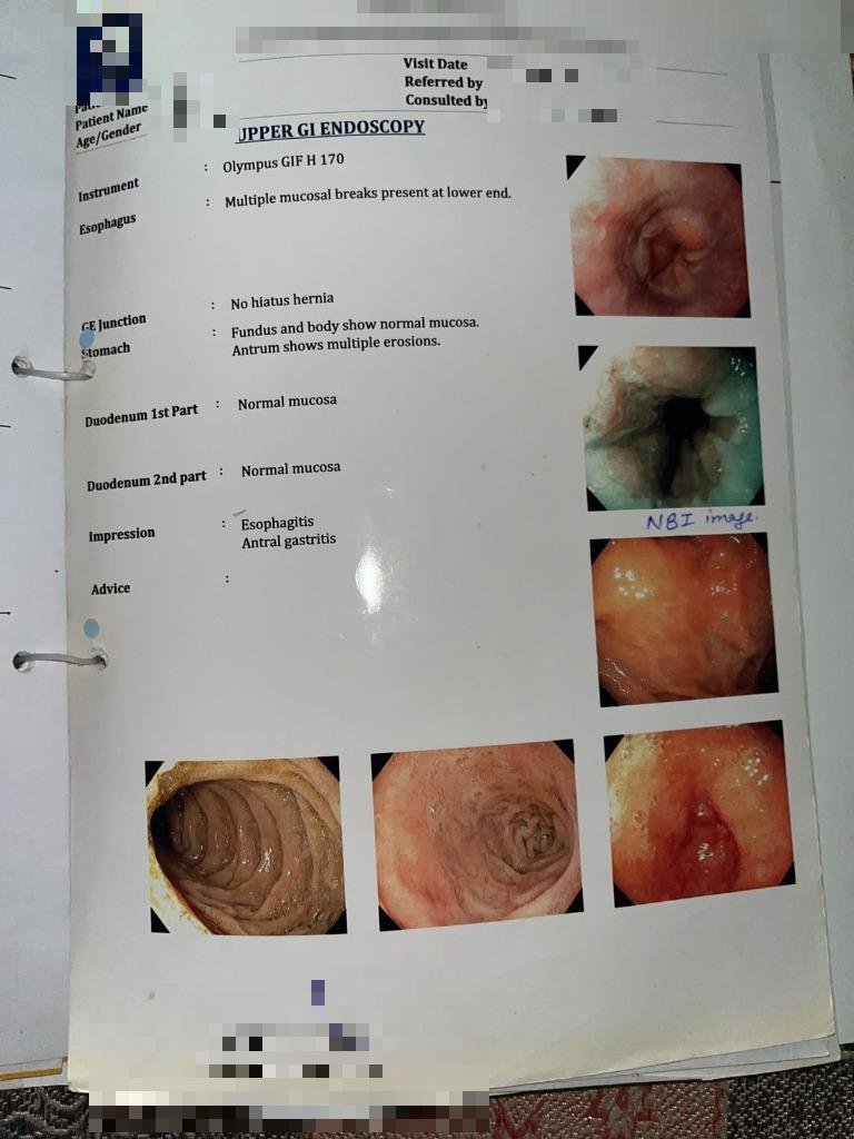 My actual upper GI endoscopy report showing esophagitis and antral gastritis